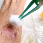 Thuisverpleging Voetzorg SaCura Sanne Jeunen zelfstandig thuisverpleegkundige Limburg regio Lanaken Genk Zutendaal thuiszorg thuisverpleegkundige thuisverpleegster verpleegster aan huis wondzorg palliatieve thuiszorg windels aandoen steunkousen aandoen medicatie klaarzetten medicatiebeheer wassen aankleden helpen met een bad of douche nemen helpen met aankleden dagelijkse hygiëne nagels knippen scheren bloedname bloednames bloed afnemen stomazorg verzorgen van stoma postoperatieve thuiszorg zorg na operaties inspuitingen wondzorg infuustherapie en sondevoeding voetzorg pedicure aan huis eksterogen eelt mycose nagelcorrectie nagelregulatie wrat frezen nagelbeugel nagels knippen