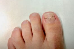 Pedicure Bilzen